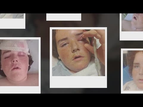 North Texas teen undergoes brain surgery after sinus infection spread to his brain