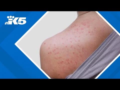 Possible measles exposure at SEA Airport