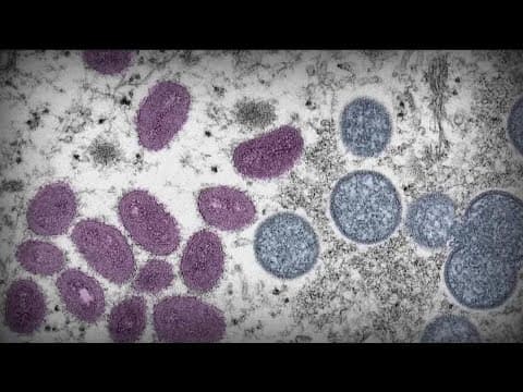 Monkeypox declared public health emergency in San Diego County