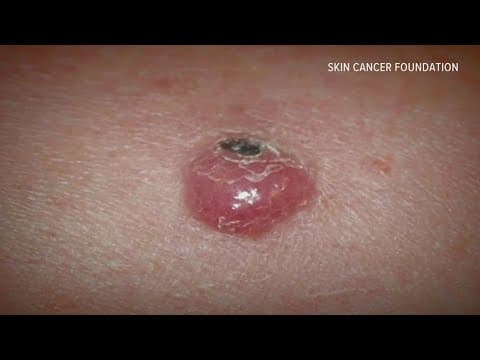 Jimmy Buffett died of same skin cancer that claimed life of Al Copeland. Is there a cure?