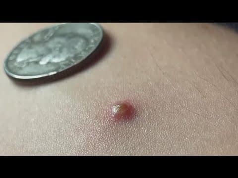 San Diego man infected with monkeypox shares his experience