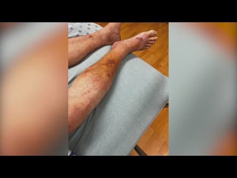 Potential new drug could target flesh-eating bacteria Vibrio