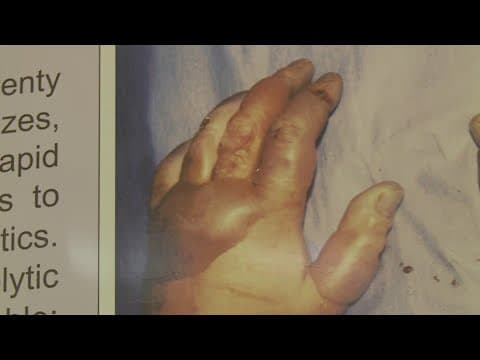 How do you treat frostbite? FDA approves first drug to treat severe frostbite