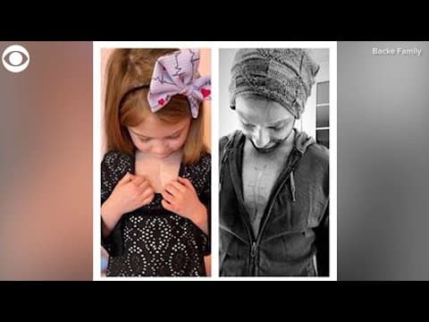 Dad gets tattoo to match daughter's heart surgery scar