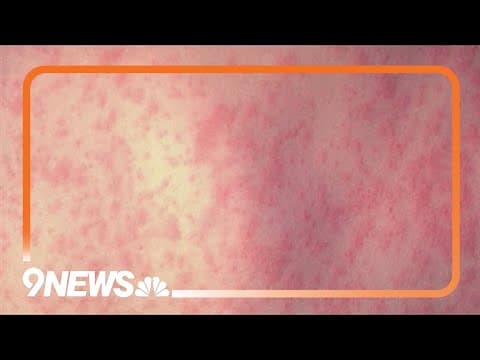 U.S. has surpassed total number of measles cases from 2024