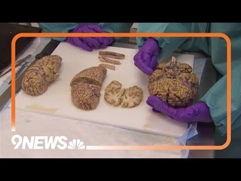 New study of human brains shows there are enough microplastics to make a spoon