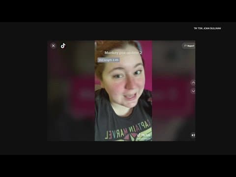 Minneapolis woman speaks out on monkeypox testing concerns