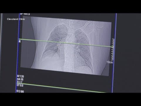 US Surgeon General issues new warning about lung cancer