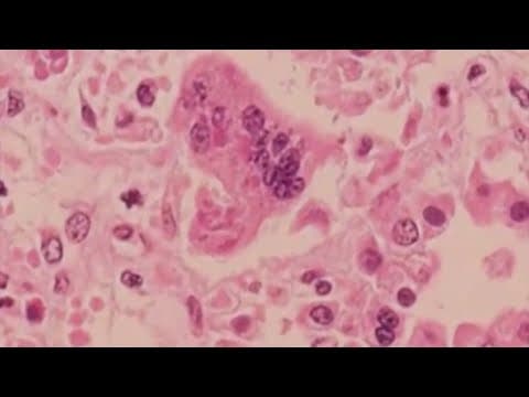 Can a face mask prevent measles exposure? Doctor answers measles questions