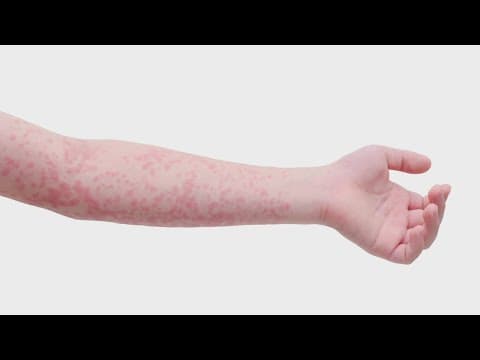 Infectious disease specialist breaks down symptoms of measles