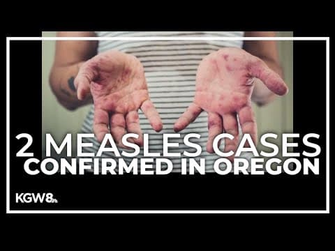 2 cases of measles confirmed in Clackamas County household