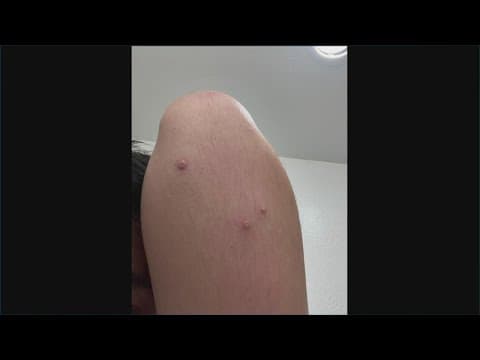 'It's an ugly, painful monster' | San Diego man infected with monkeypox shares his experience