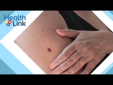 What to know about skin cancer risks: HealthLink