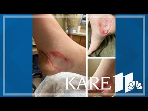 Minnesota man suffers burns after rechargeable insoles explode inside his boots