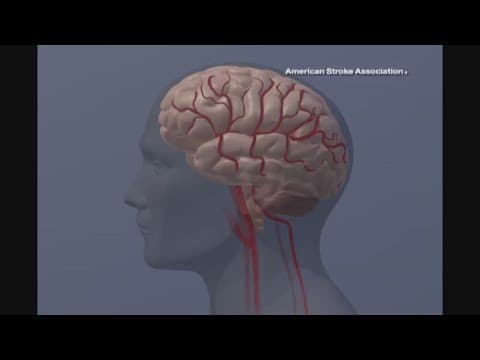 Here are warning signs to monitor for a possible stroke