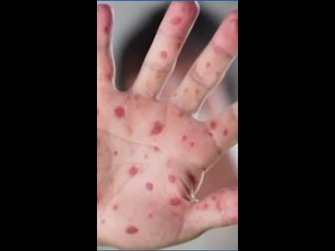 Measles cases in the US continue to rise after already reaching highest count in 30 years