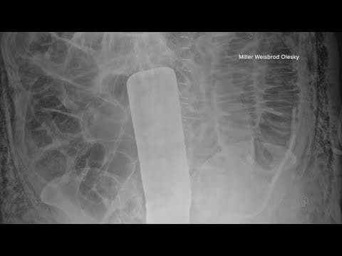 Baylor Scott & White sued by patient who claims surgeons left metal retractor inside him