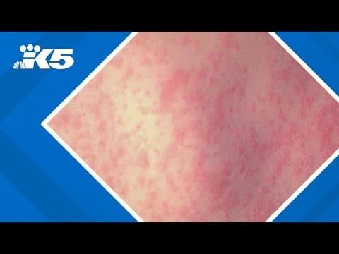 308 measles cases reported in the U.S. so far this year