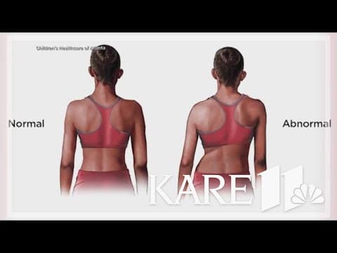 Scoliosis signs every parent should know