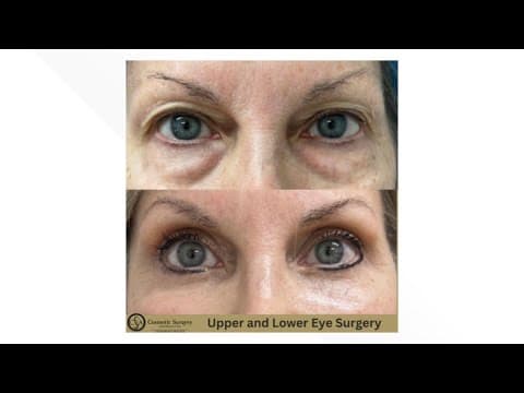 Everything you need to know about the cosmetic eyelid surgery process