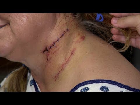 Dog attack leaves Montgomery County woman severely injured