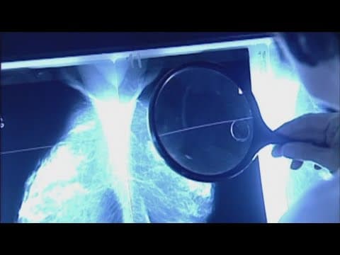 New guidelines recommend mammograms start at 40