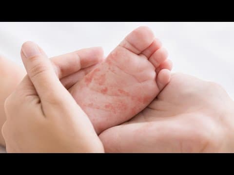 First central Indiana case of measles reported in Putnam County