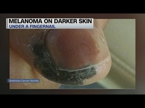 How to spot cancer on darker skin
