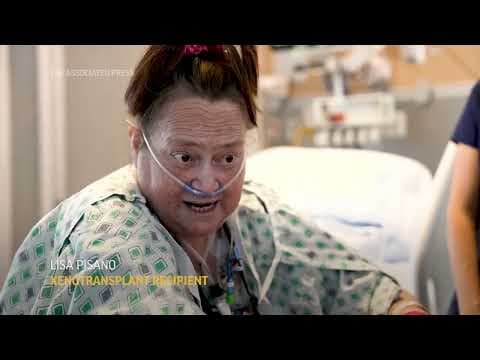 Doctors combine a pig kidney transplant and a heart device in a bid to extend woman's life