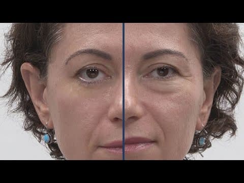 Get rid of wrinkles without injections using Plexaderm for only $14.95