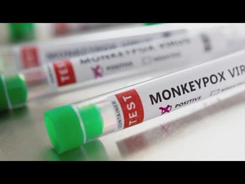 Man in Columbus area diagnosed with monkeypox