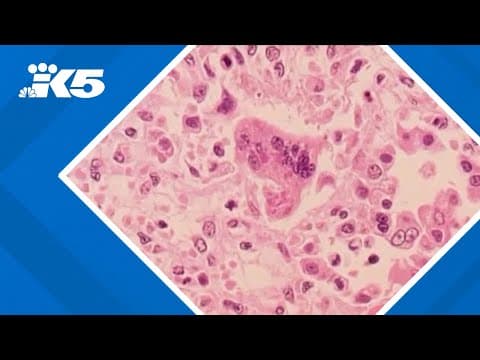 First case of measles in WA this year identified, officials warn of King County exposure locations