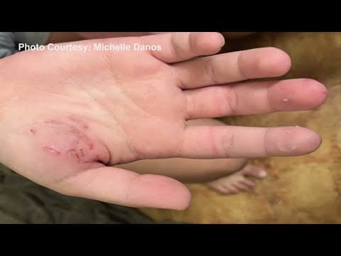 Multiple fox attacks reported in San Marcos, Texas