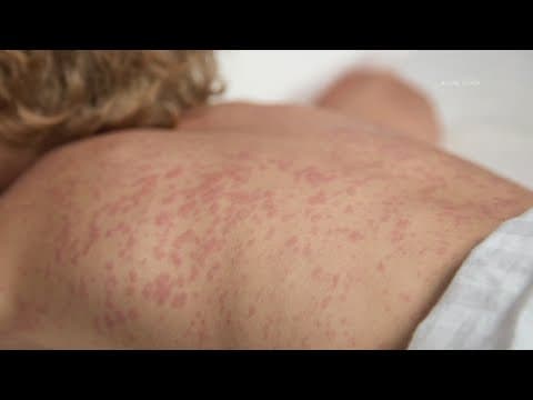 15 cases of measles reported in small West Texas county with high rate of vaccine exemptions