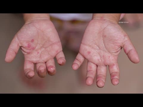 More than 680 confirmed measles cases in Texas