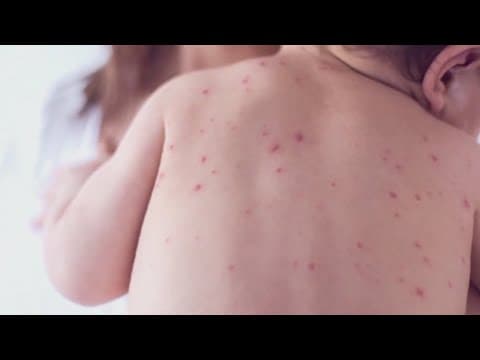 What are measles? An East Tennessee doctor explains