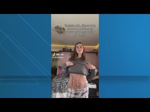 What is ‘Toasted Skin Syndrome’? Experts explain the viral condition