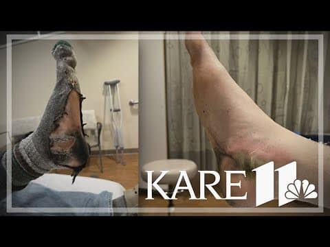 Electronically heated insoles leave MN man with third-degree burns, medical professionals say to sta