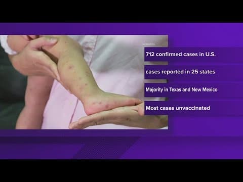 Texas health department reporting 541 cases of measles on Friday