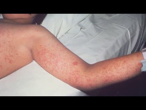 New measles cases spread in Texas