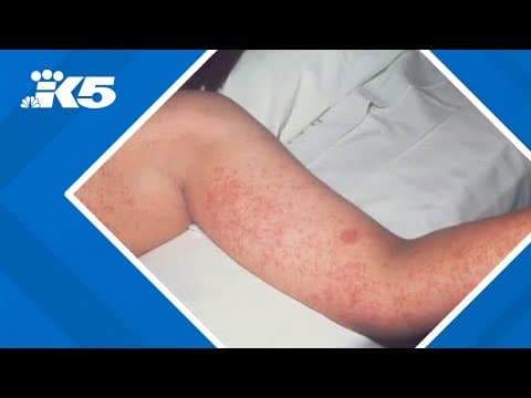 Measles reported in 8 states in US so far this year