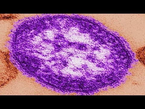 Harris County health department reports measles case in child younger than 18