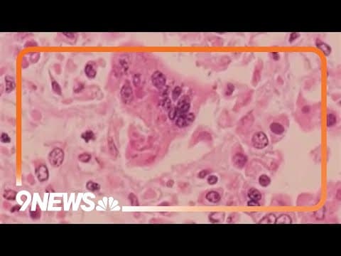 Health officials provide update on measles case in Colorado