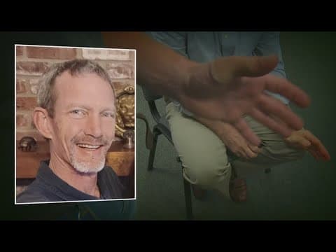 First 3D printed thumb in U.S. attached to La. veteran