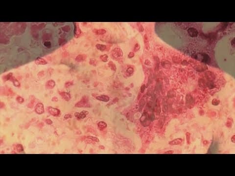 LDH confirms second measles case in the Greater New Orleans area