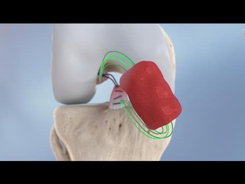Scripps Clinic debuts new implant to heal knee ligament tears