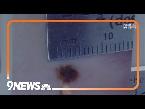 Dermatologist gives advice on protecting against melanoma