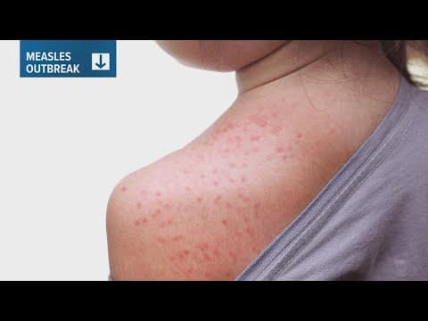 Texas measles outbreak: Officials warn Texas State, UTSA and San Antonio visitors may be exposed