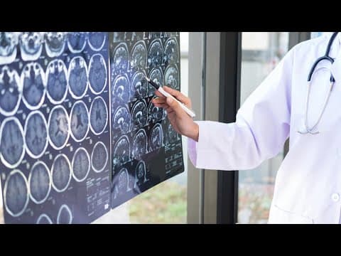 Doctors seeing more strokes in people ages 18-49