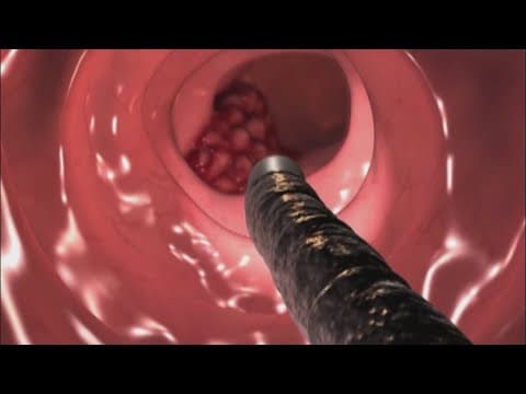 Colon cancer at-home-test study